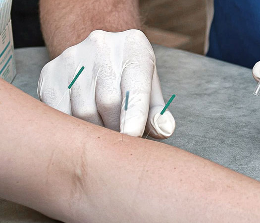 Dry Needling: An expert physical therapist from All-Pro Physical Therapy providing Dry Needling Therapy